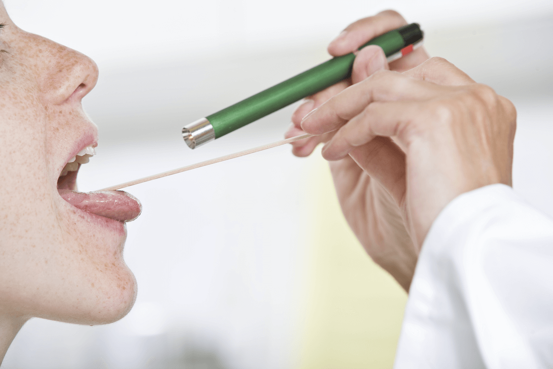 Strep Throat Pictures